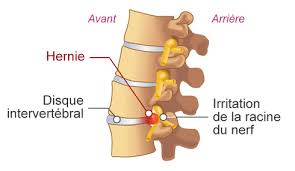 Hernie discale et douleur Hernie discale et douleur